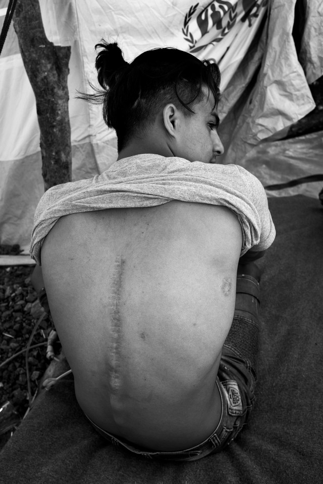 A minor Syrian paralyzed showing his bullet wound at the Olive Grove informal extension to the refugee camp Moria, Lesbos, Greece